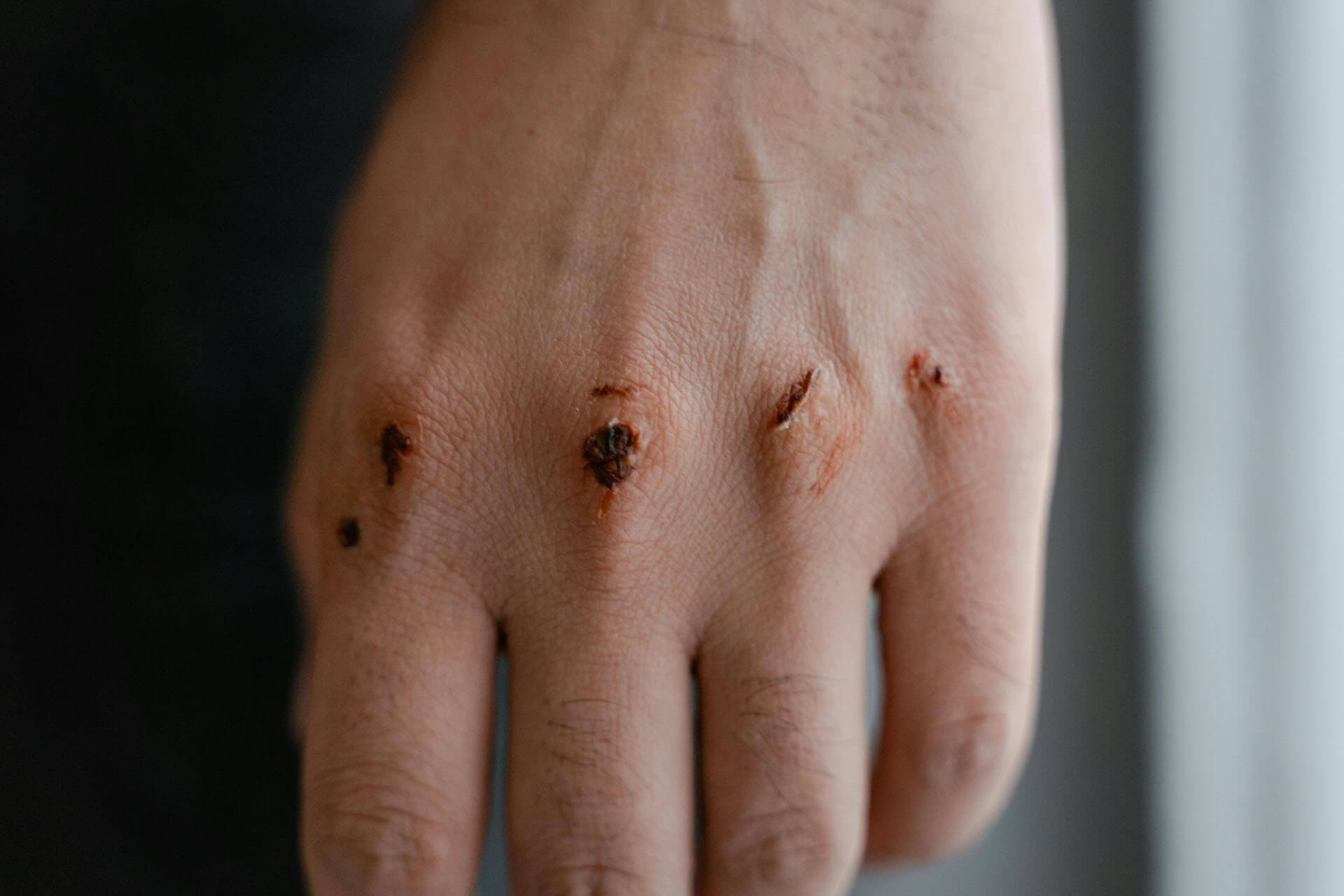 Närbild på sårskador och rivmärken på hand.